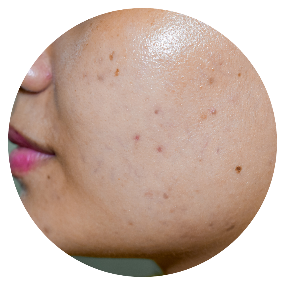 Pimples